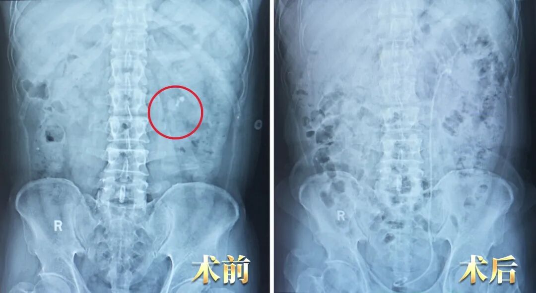 一面锦旗，十年信任：结石体质患者的两次选择【四川肾结石医院】(图2)