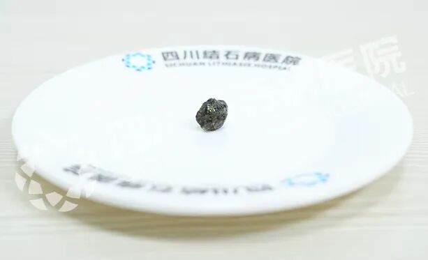 从“大山压胸”到一身轻松，他连连点赞“保胆”！【四川保胆取石医院】(图1)