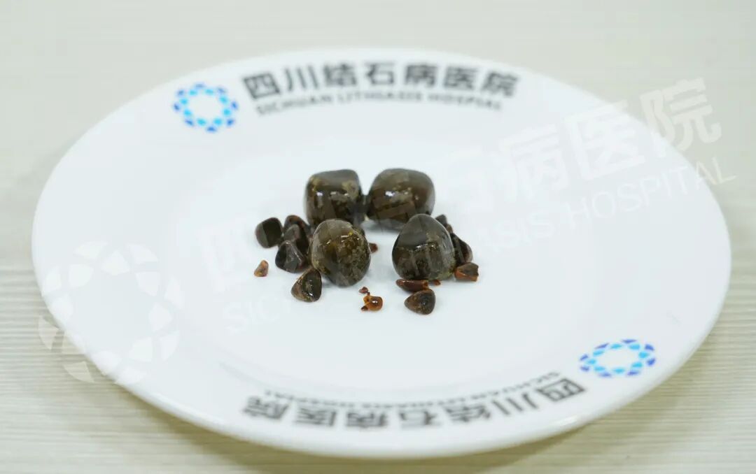 新疆患者千里来院 赴与国之名医刘京山教授的“保胆之约”(图1)