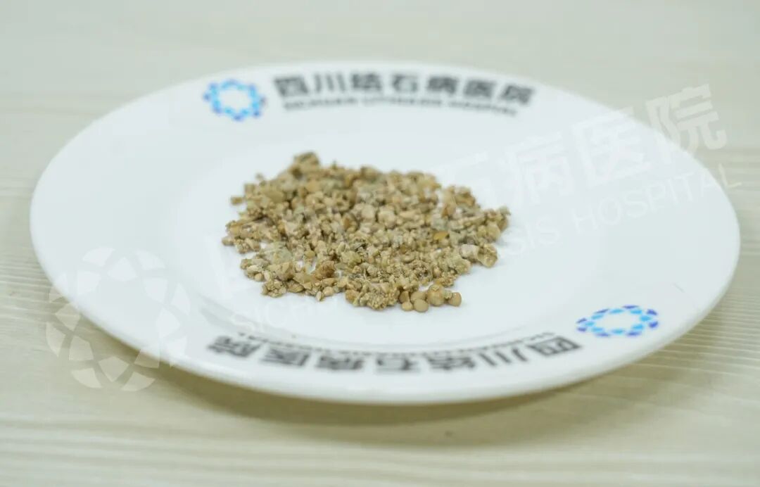 又一颗复杂「鹿角形铸型结石」，四川结石病医院专家一次性“清剿”！(图1)