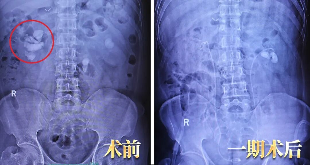 又一颗复杂「鹿角形铸型结石」，四川结石病医院专家一次性“清剿”！(图2)
