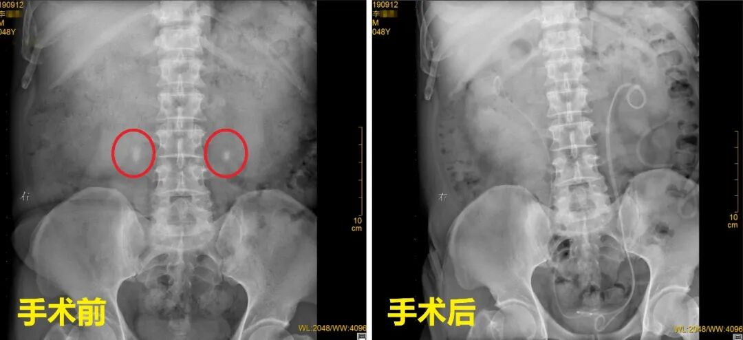 盲目碎石吃药，双侧输尿管被“石头”堵死！【四川24小时碎石医院】(图1)