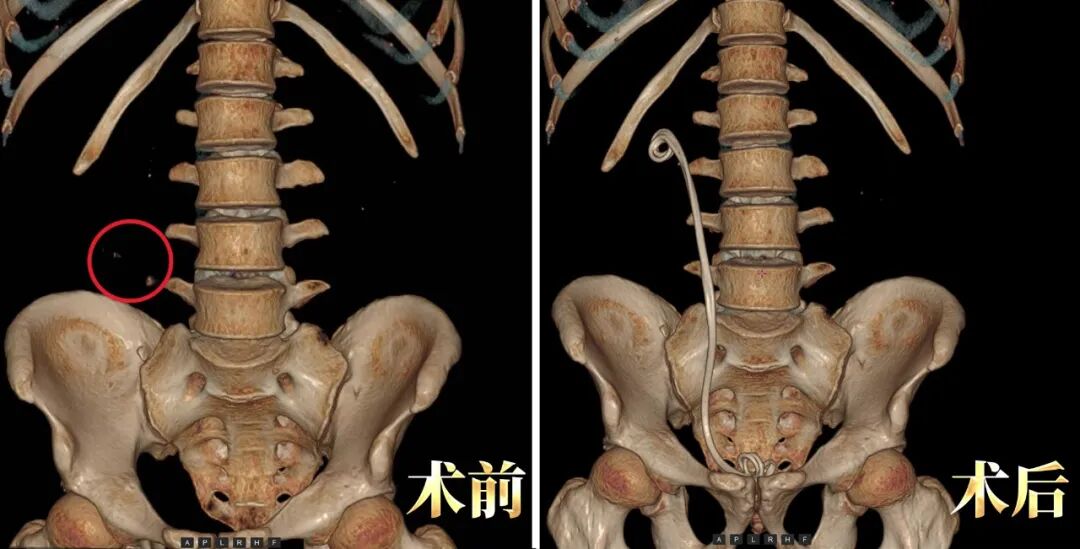 外院三战三败！四川结石病医院专家破解结石“不死之谜”(图2)