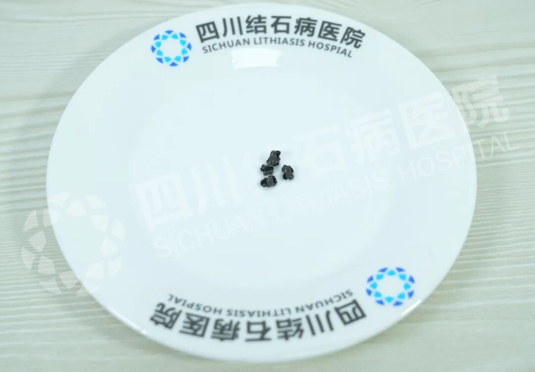 青少年儿童胆结石高发，切还是保？这个暑假很多家长这样选(图1)