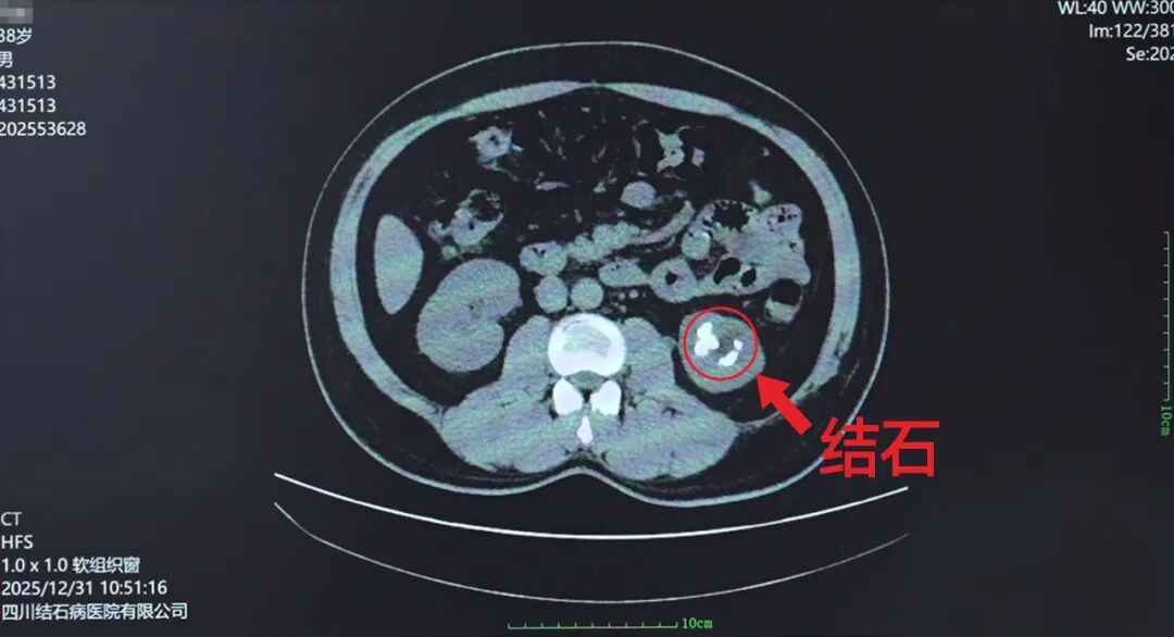 5公分超硬“金刚石”！不打孔如何“智取”【四川肾结石专科医院】(图2)