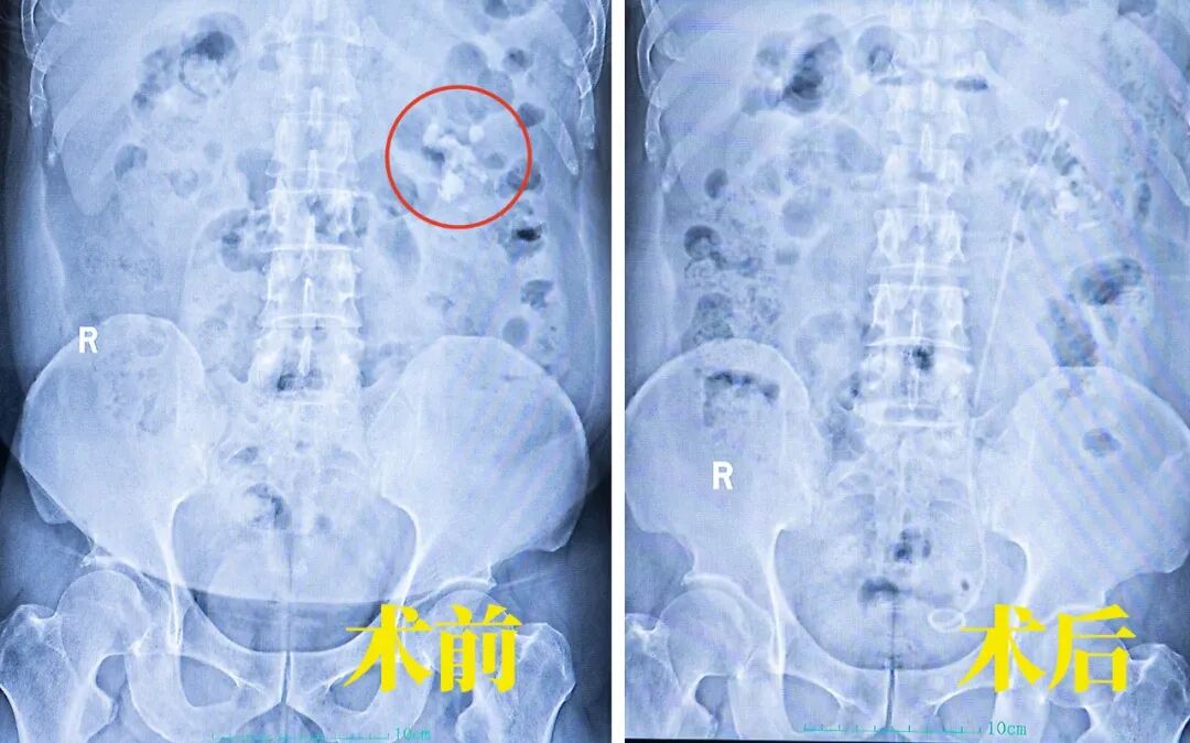 5公分超硬“金刚石”！不打孔如何“智取”【四川肾结石专科医院】(图3)