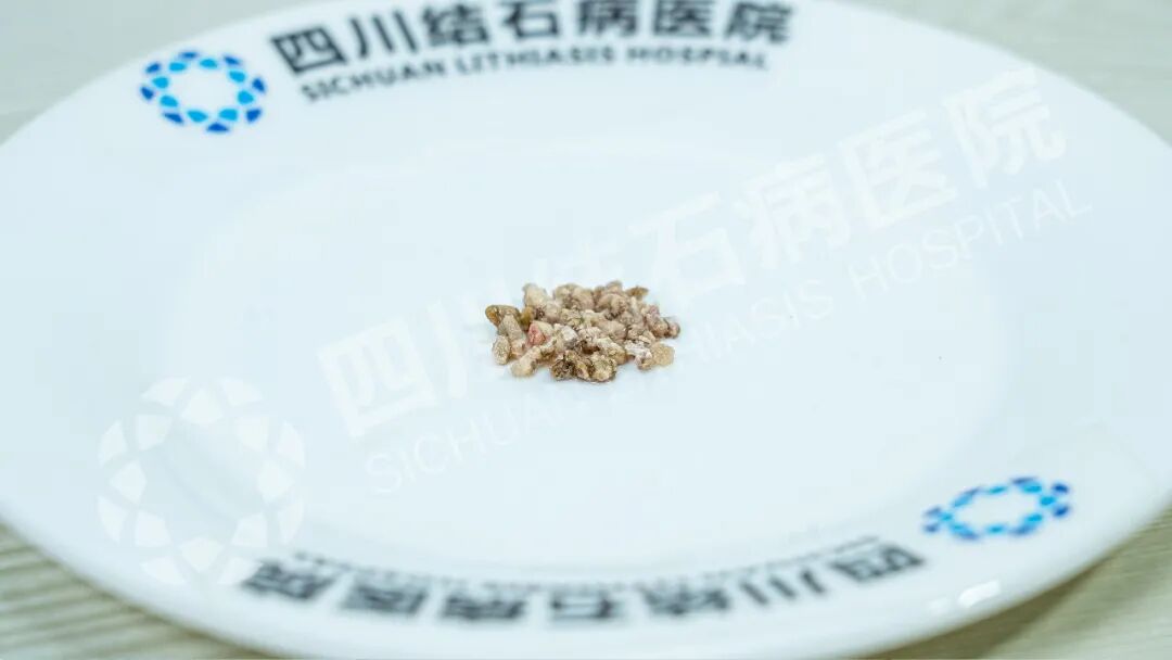 5公分超硬“金刚石”！不打孔如何“智取”【四川肾结石专科医院】(图1)