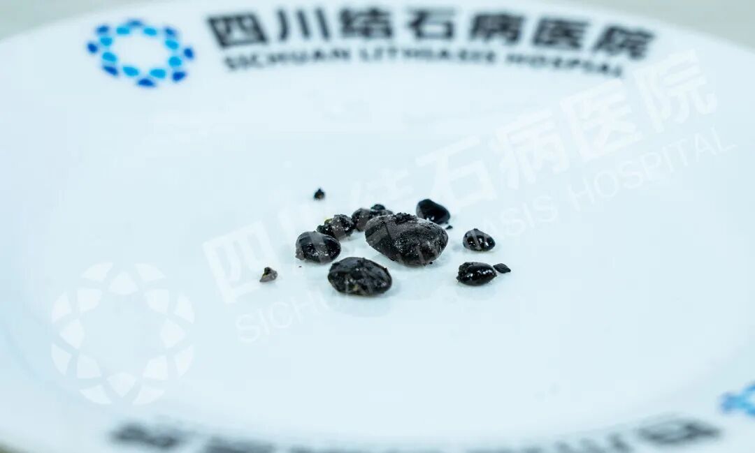 能不能保胆，关键看什么？四川保胆取石医院(图1)