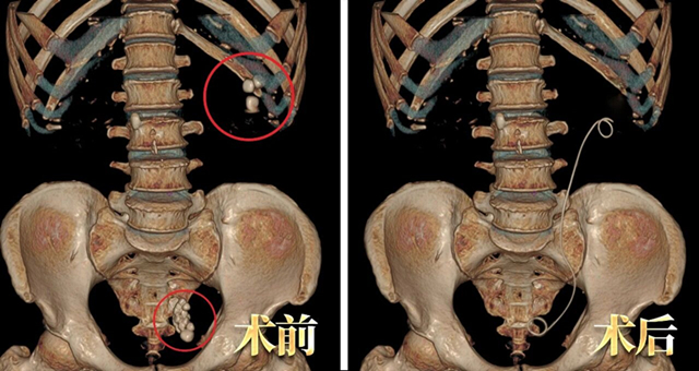 吓人！输尿管竟成“结石窝”！如何端掉这个“老巢”？【成都保肾取石医院】(图1)