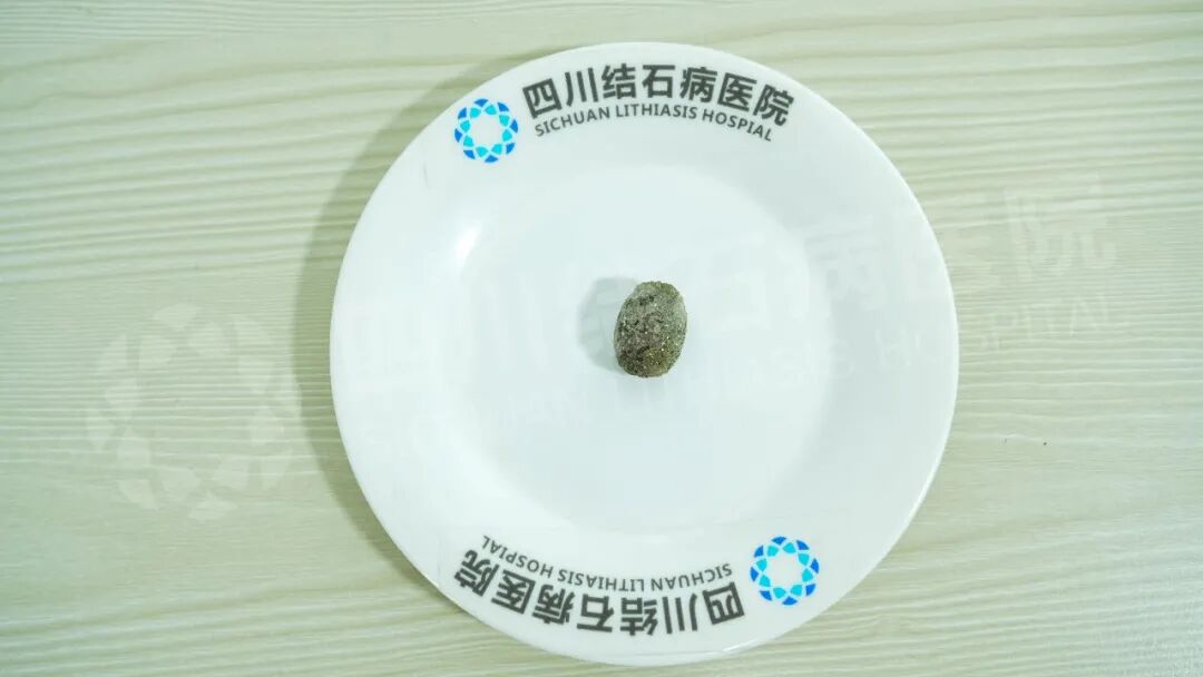 哥哥是医生，为何把他“推”到四川结石病医院保胆？(图1)