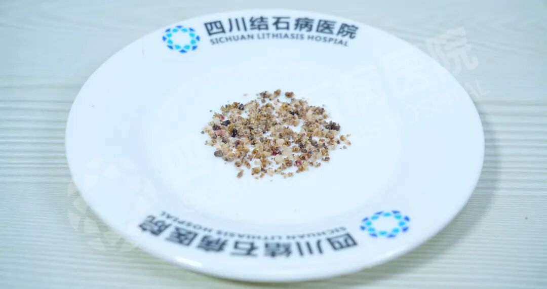 当三名合并严重疾病的患者遇结石，三台“硬仗”如何打赢？(图10)