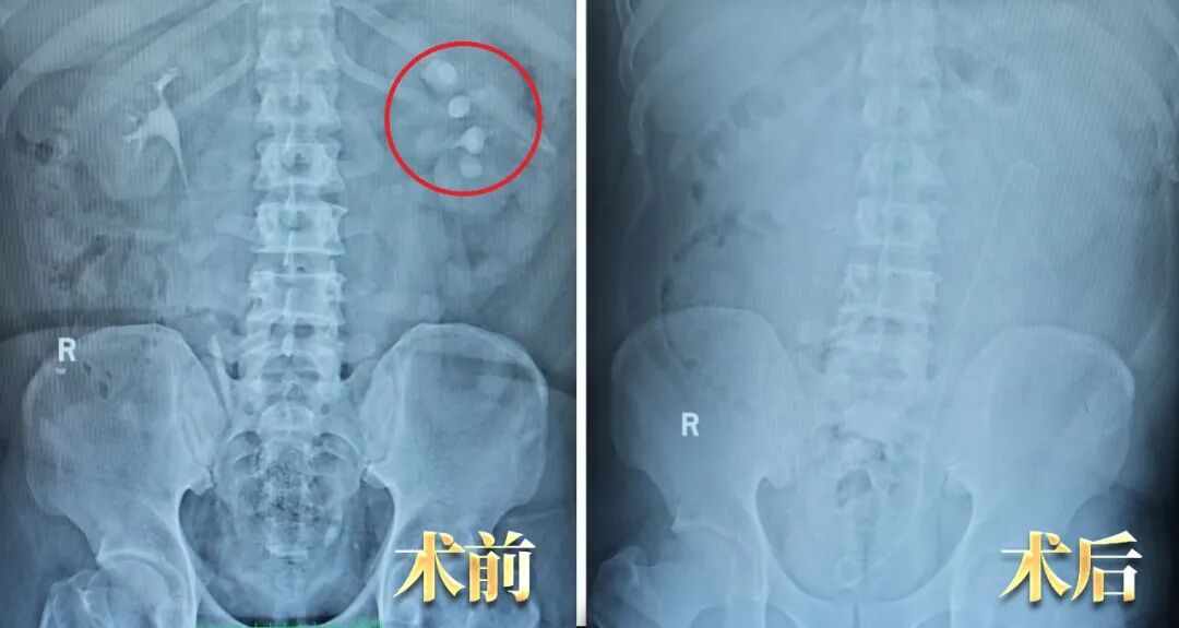 当三名合并严重疾病的患者遇结石，三台“硬仗”如何打赢？(图15)