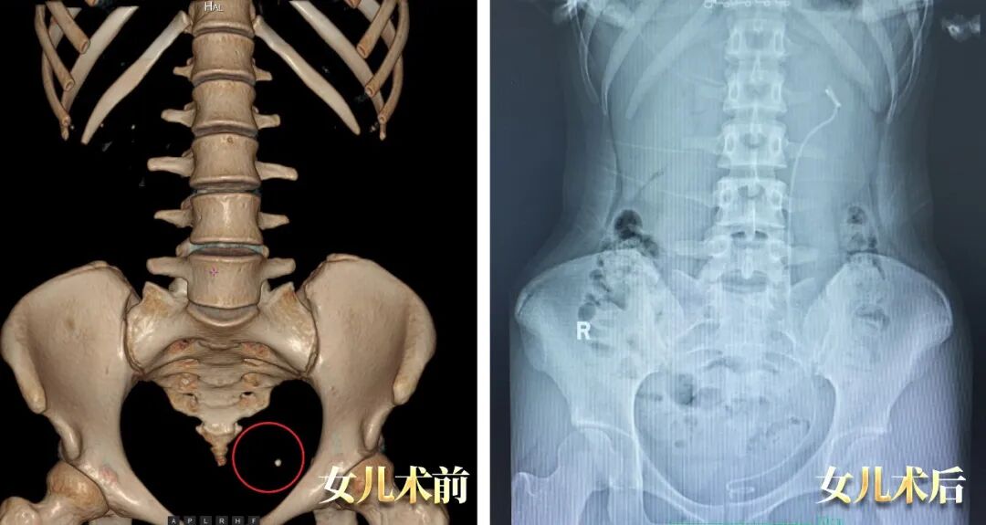 母女俩同患泌尿结石，为何坚定选择四川结石病医院？(图2)