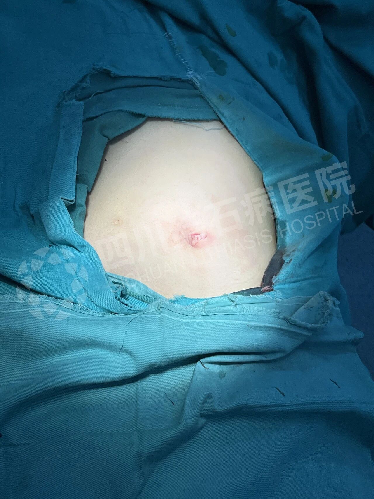 肚脐里做手术？15岁女孩的暑假“保胆记”【四川结石病医院】(图3)