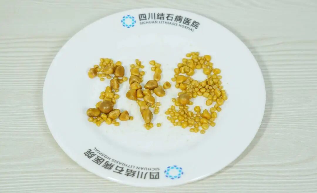 【媒体报道】26岁小伙保胆取出248颗结石,竟是因长期吃外卖(图2) 【媒体报道】26岁小伙保胆取出248颗结石,竟是因长期吃外卖(图2)